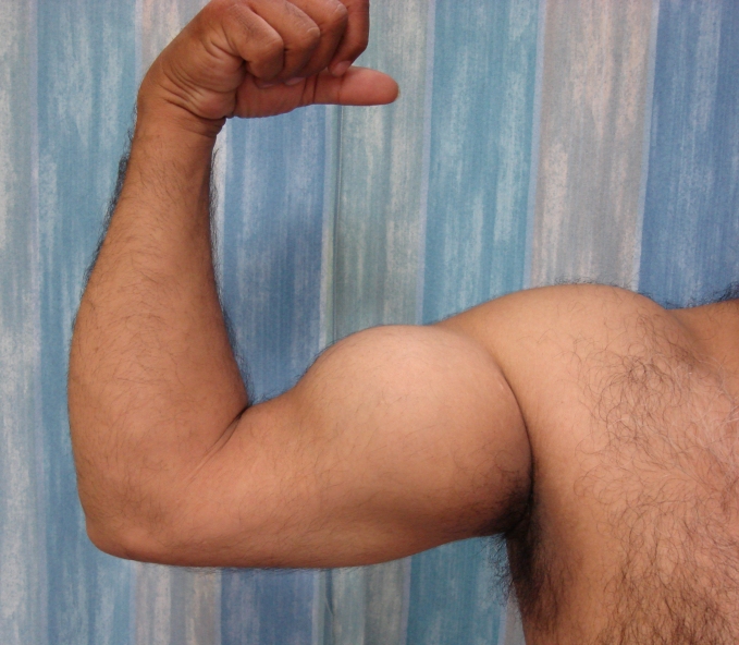 Distal Biceps Tendon Injury