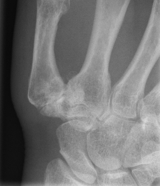 Base of thumb arthritis