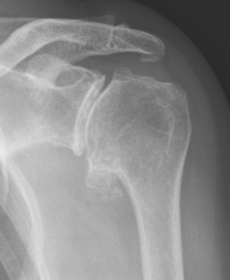 advanced osteoarthritis in the shoulder with prominent bone spurs and loose bodies